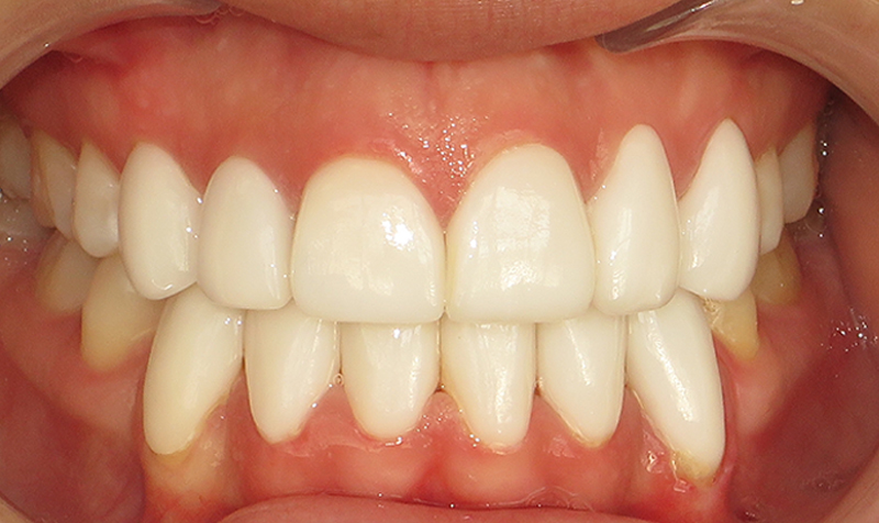 Invisalign Case (After)