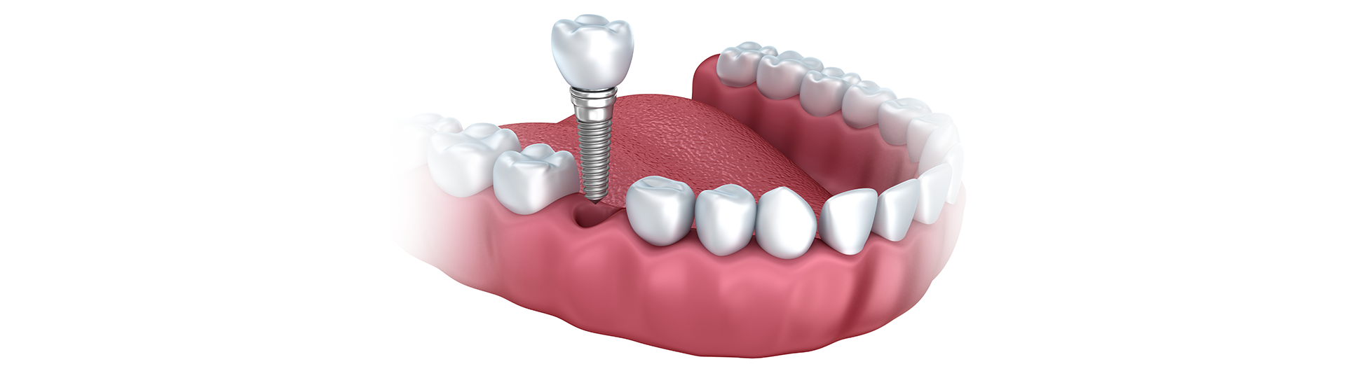 3D rendered diagram to help answer the question, how do dental implants work?